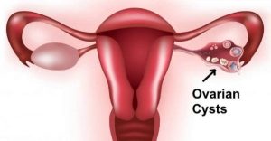 Ovarian Cyst