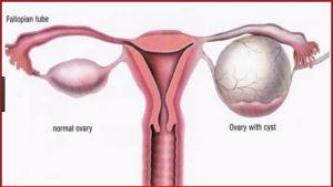 Ovarian Cyst