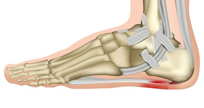 Learn about the treatment for Plantar Fasciitis