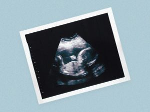 The ABC's of Ultrasound in Pregnancy