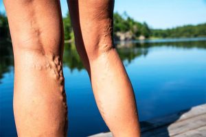 varicose vein treatment in Chandigarh